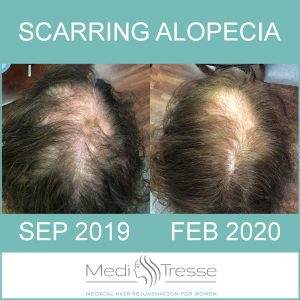 Update on Treating Scarring Alopecia