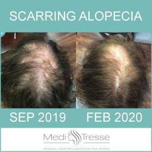 Update on Treating Scarring Alopecia Update on Treating Scarring Alopecia