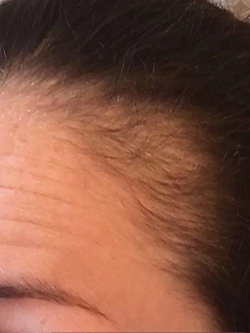 A patient showing hair loss from Telogen Effluvium before treatment with Medi Tresse.