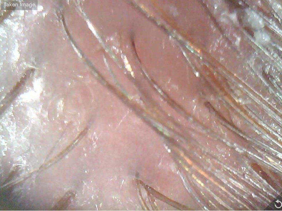 Scalp Care Routine is the key to the prevention of women's hair loss. Medi Tresse Professional Scalp Exfoliation. 