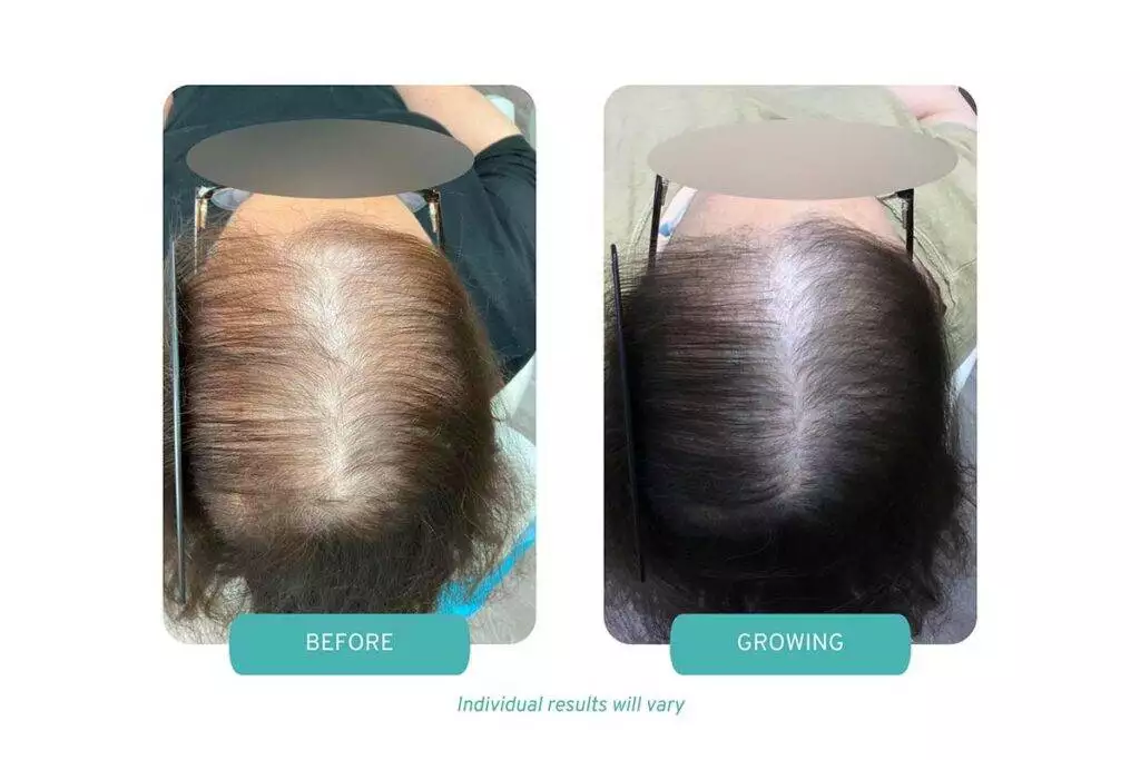 Dual Treatment for Androgenic Alopecia (Female Pattern Hair Loss) in Wellesley, MA Office