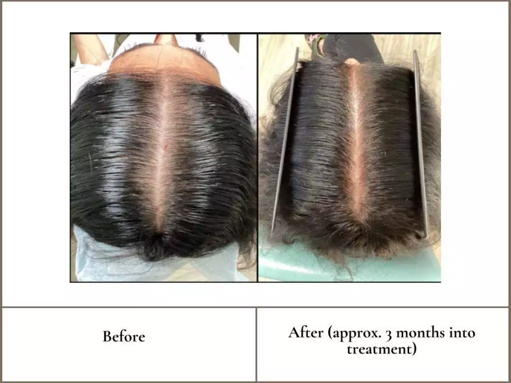 New PDO Threads Treatment for Hair Regrowth & Restoration
