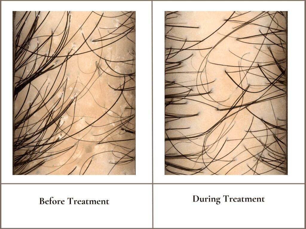 Before and Growing example of Luxury Scalp Treatments for Scalp Health in Wellesley, MA.