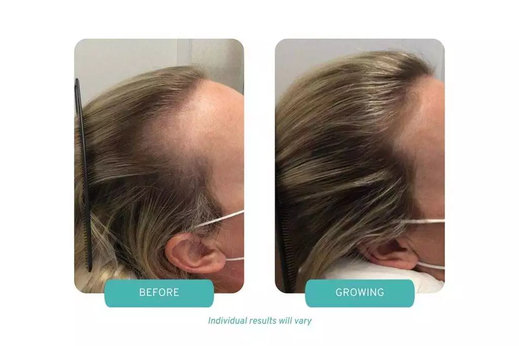Optimal Platelet Concentration™ Therapy Case Study Overview for Androgenic Alopecia in Worcester, MA Office