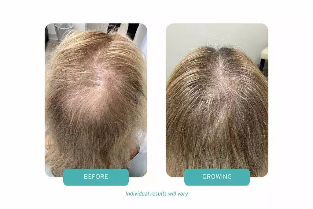 Painless OPC Therapy for androgenic alopecia in westchester NY - Case Study