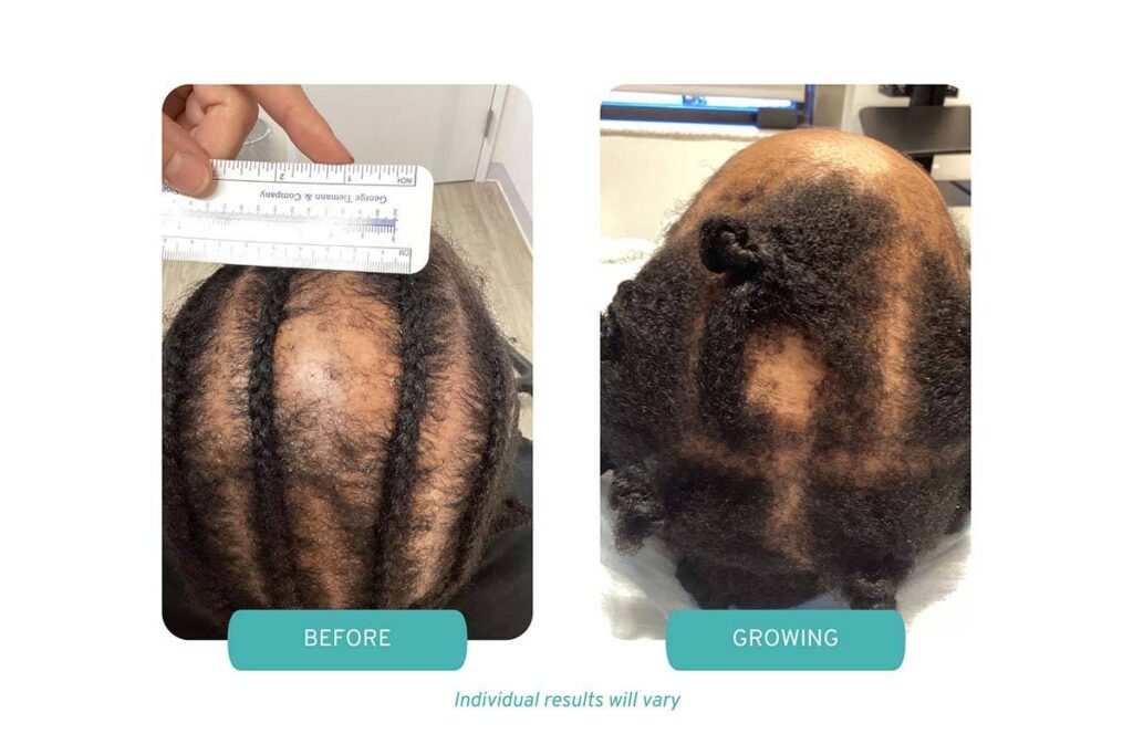 Case study #10 combination therapy for scarring alopecia before and growing example 