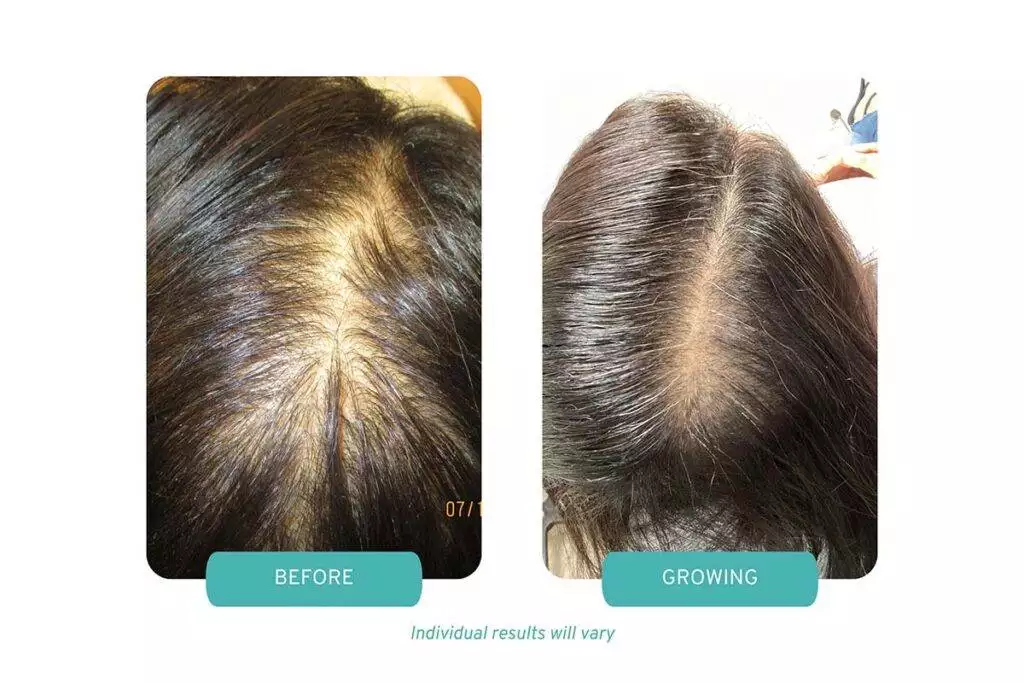 Case Study 12 from Medi Tresse for PRP Therapy for Androgenic Alopecia showing before and growing example of this patient. These images are eighteen months apart.