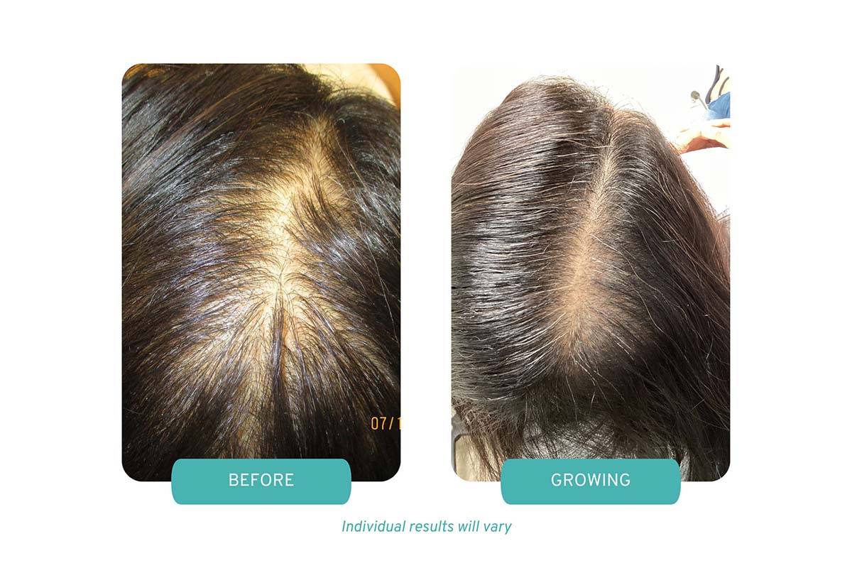 prp-therapy-for-androgenic-alopecia-scarsdale-ny-medi-tresse