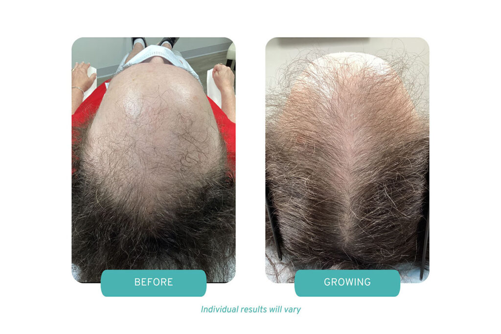 A before and after of a patient with androgenic alopecia with combination therapy treatments of PRP Therapy in Westchester NY and Low-Level Laser Therapy in Westchester NY
