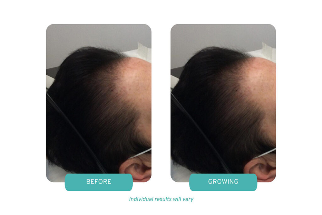 A before and after photo of case study patient going through treatment with Low-Level Laser Therapy and Painless PRP for female hair loss. 