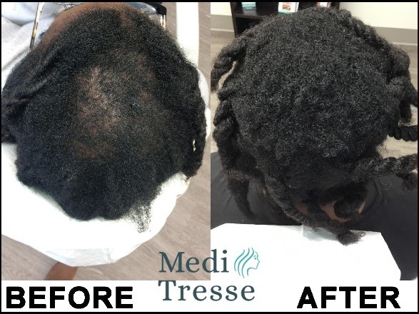 Central Centrifugal Cicatricial Alopecia (CCCA) is a type of Scarring Alopecia. This is a before and after of a patient of Medi Tresse.