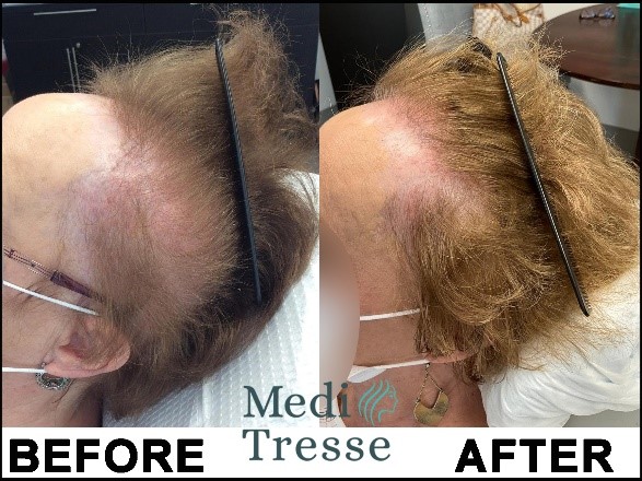 Frontal Fibrosing Alopecia (FFA) is a type of Scarring Alopecia. This is a before and after of a patient of Medi Tresse.