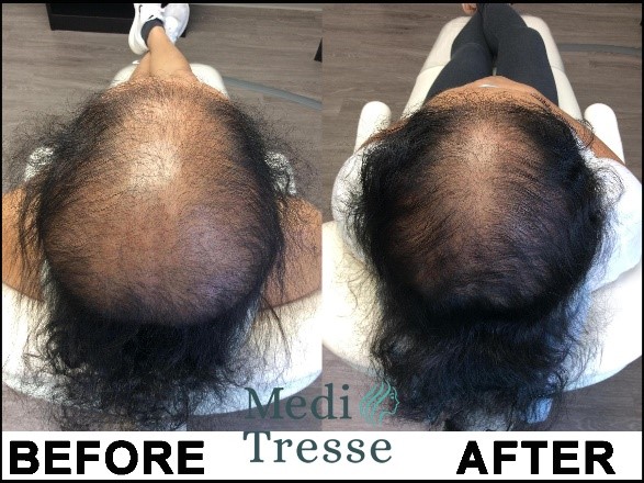 Lichen Planopilaris (LPP) is a type of Scarring Alopecia. This is a before and after of a patient of Medi Tresse.