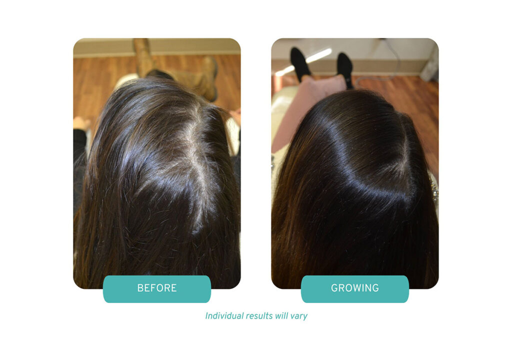 Boston-Magazine-womens-hair-loss-treatment-female-hair-loss-boston-before-and-growing.