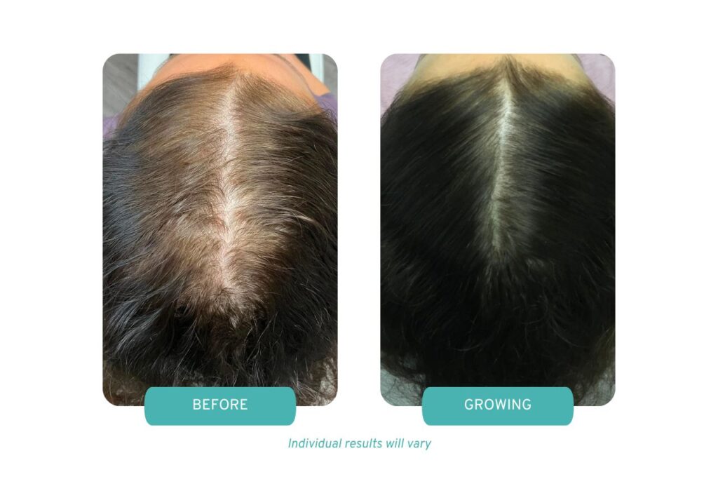 Before and Growing results of Painless PRP in Worcester MA at Medi Tresse.