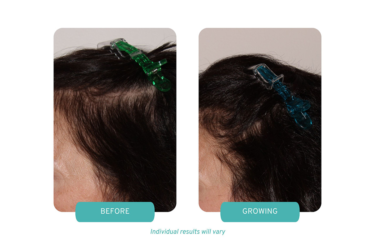 Medi-Tresse-Thinning-Hair-Treatments-Before-and-After-Left.