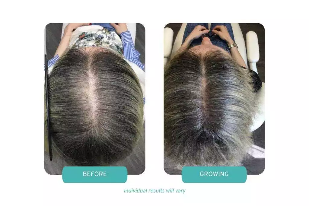 Post Chemotherapy Hair Loss Treatments. A before and after photo of a post chemo patient using Painless PRP to treat post chemotherapy hair loss.