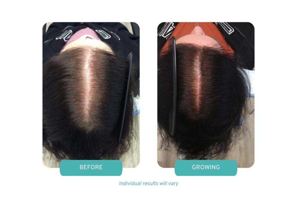 Before and growing photos of a patient for OPC Therapy for female hair loss at our Worcester, MA location.