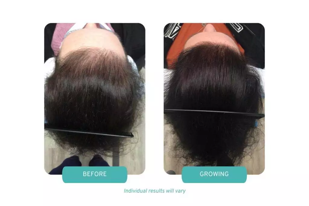 Before and growing photos of a patient for OPC Therapy for female hair loss at our Worcester, MA location.