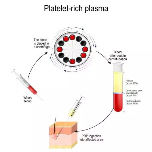 platelet-plasma