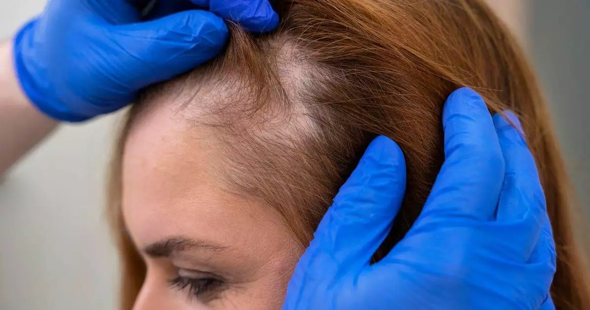 woman suffering Postpartum Related Hair Loss