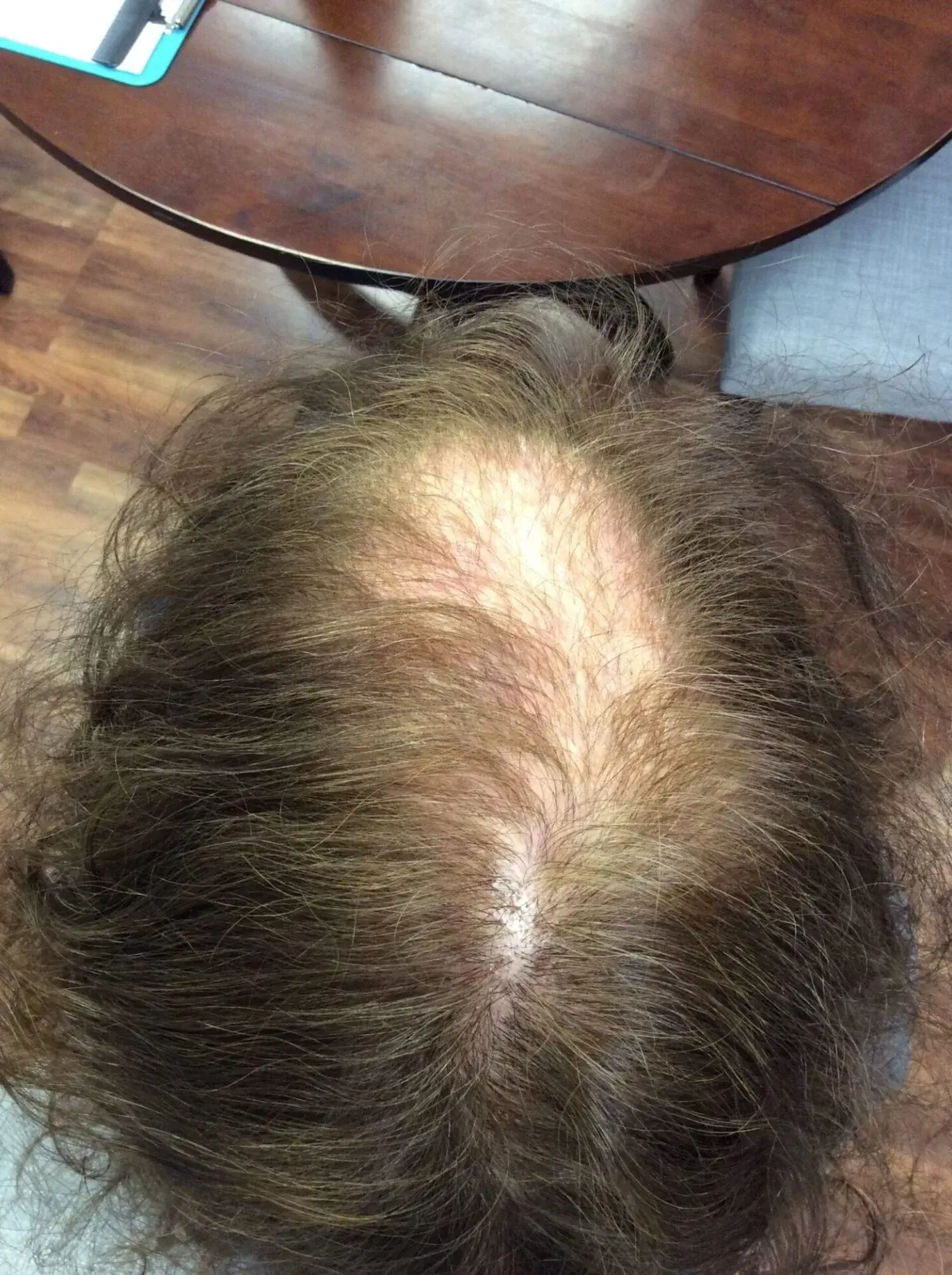 An after photo of a patient with hair regrowth after treatments with Medi Tresse.