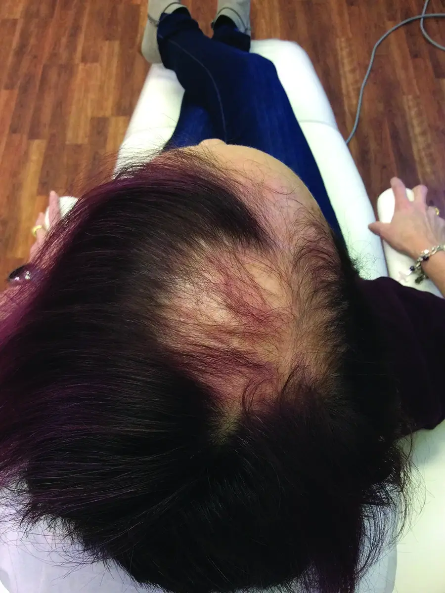 After photo after treatment