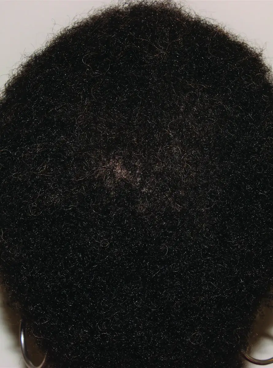after treatment