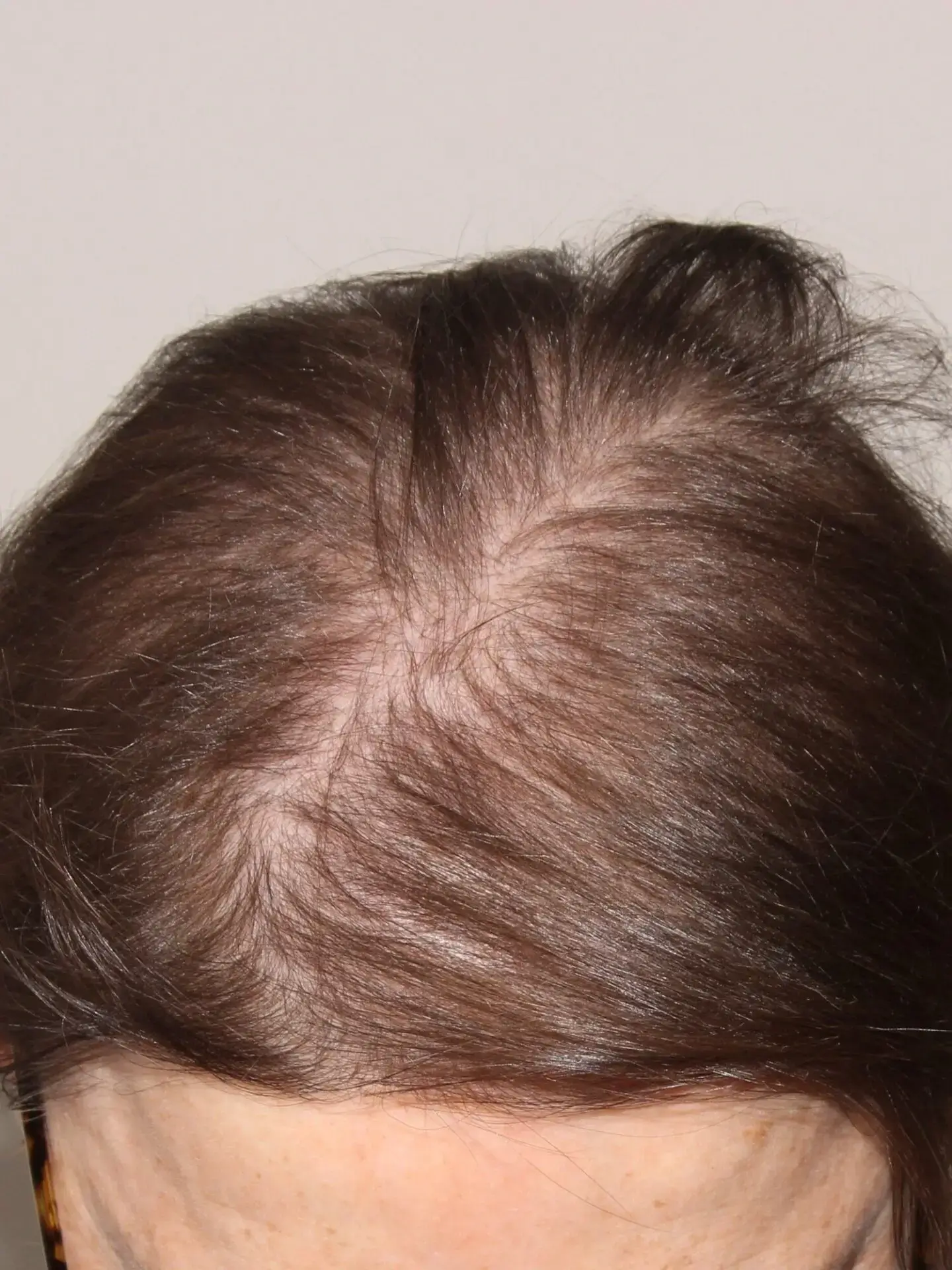Before transplant