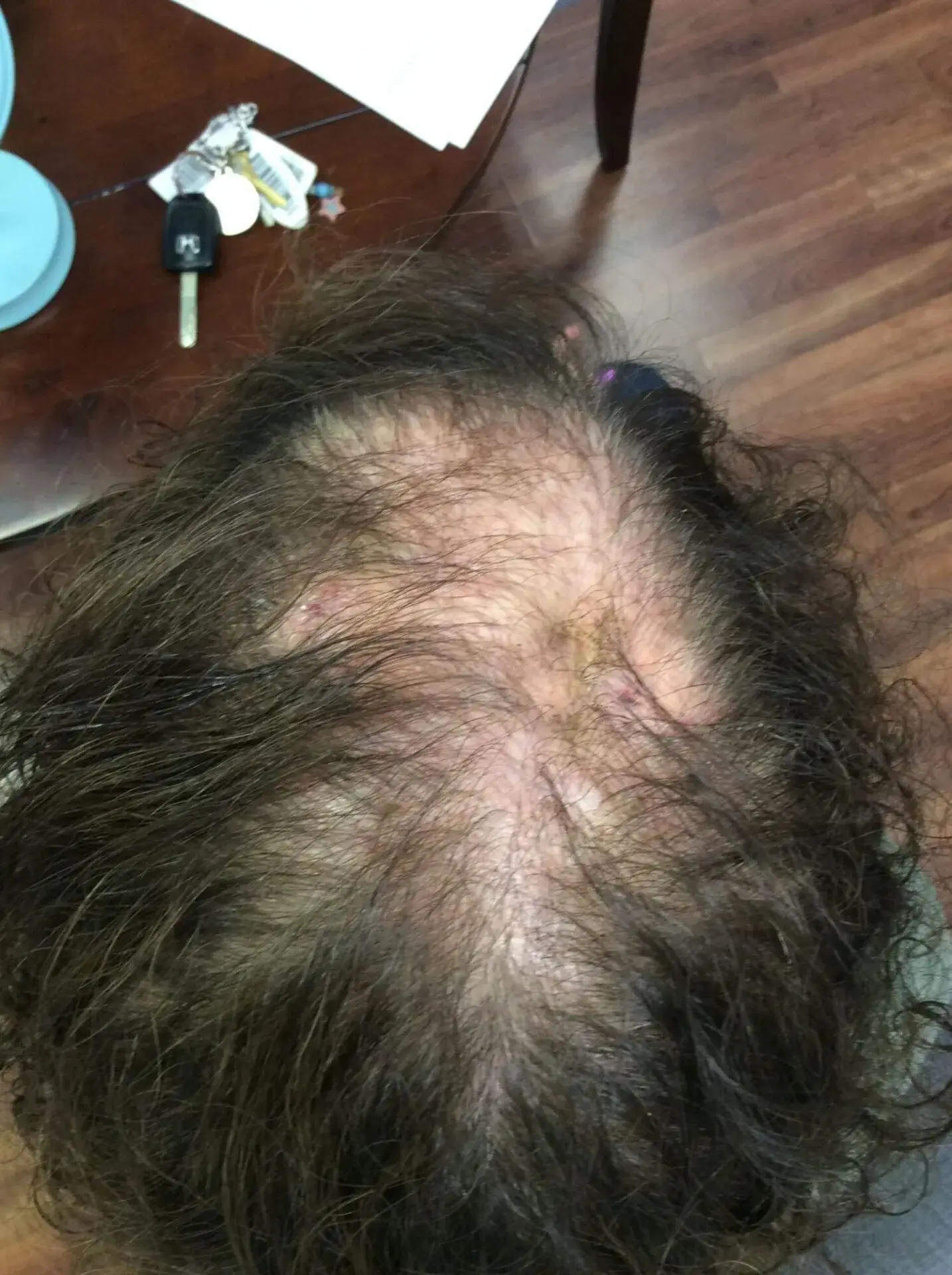 A patient showing hair loss before treatment with Medi Tresse.