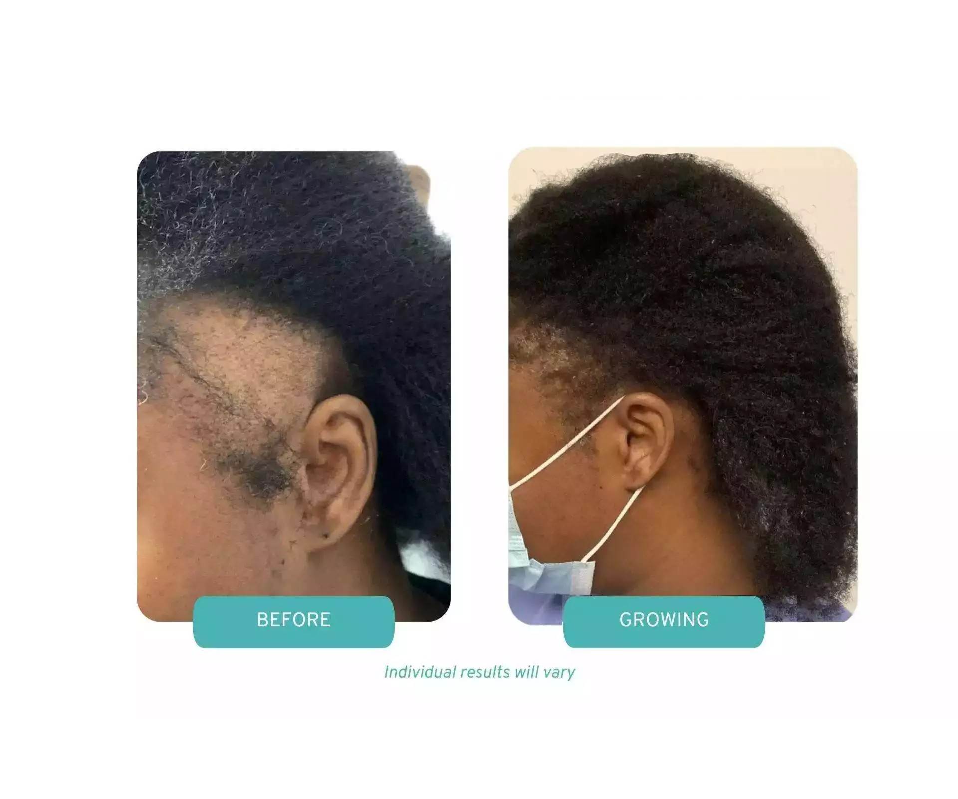 before after image of a female hair transplant.