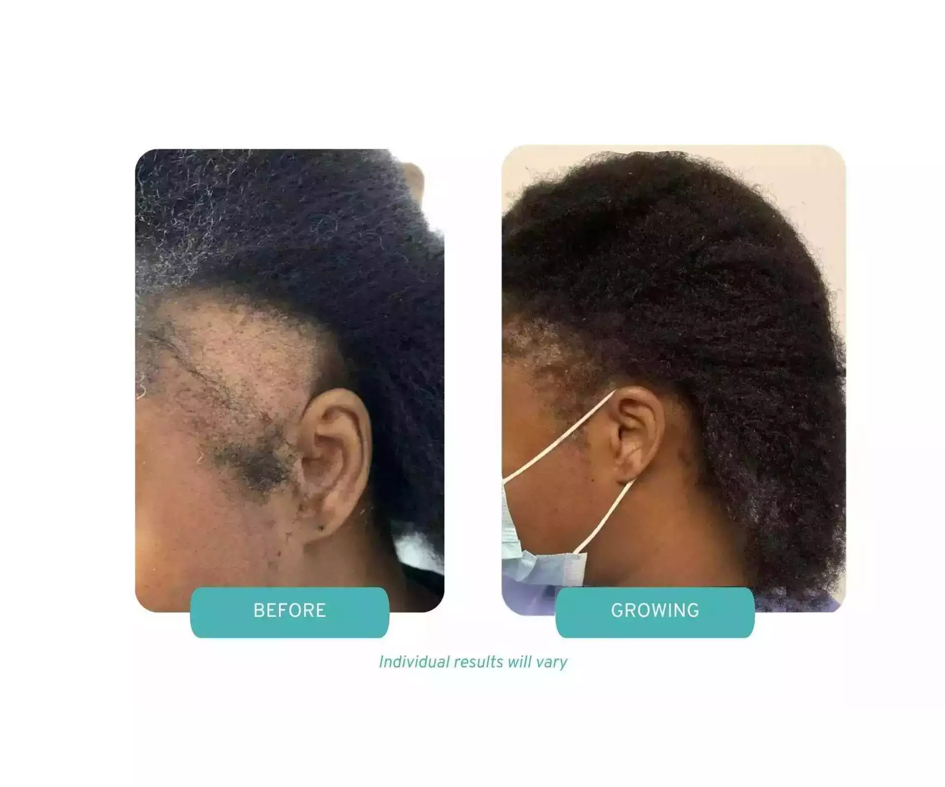 before after image of a female hair transplant.